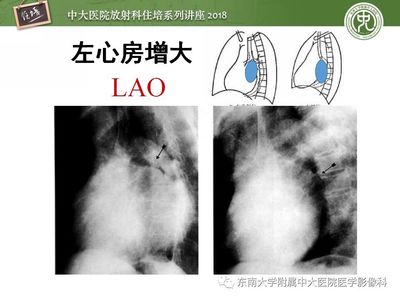 左心脏增大是怎么回事