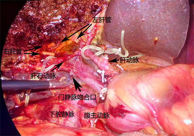 肝管瘤怎么治疗方法