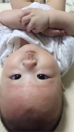 6个月宝宝出疹子症状