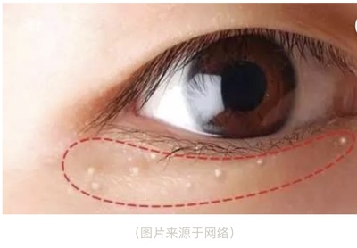 眼部脂肪粒如何去除