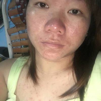 为什么背上胸前长痘痘