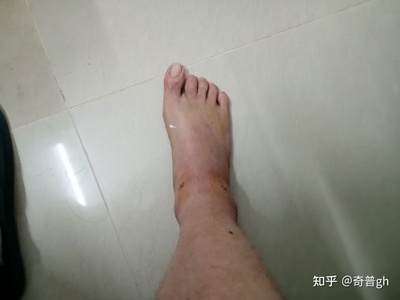 脚脖肿是怎么回事