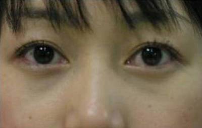眼袋大是怎么回事