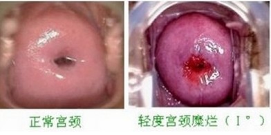 宫颈糜烂两度怎么治疗
