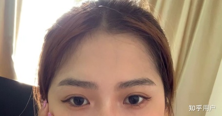 双眼皮疤痕多久才淡化