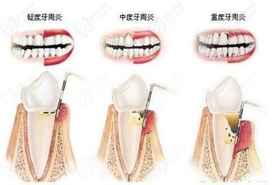牙周炎早期怎么治疗