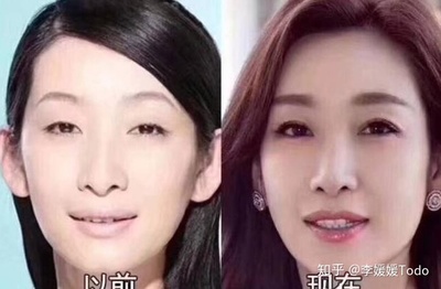 割了双眼皮后特后悔