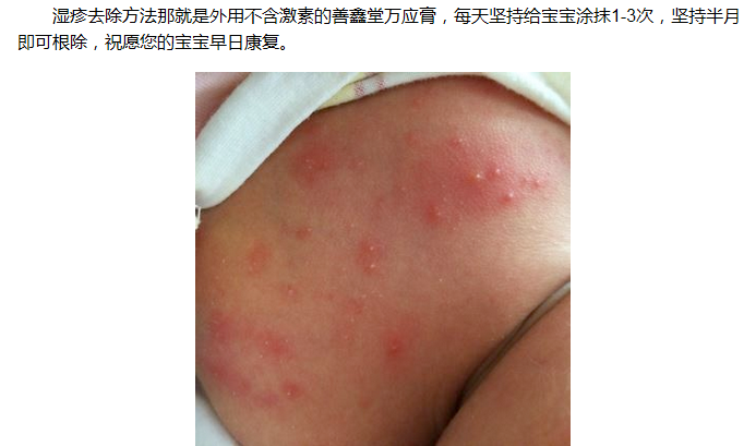 儿童皮疹怎么治疗