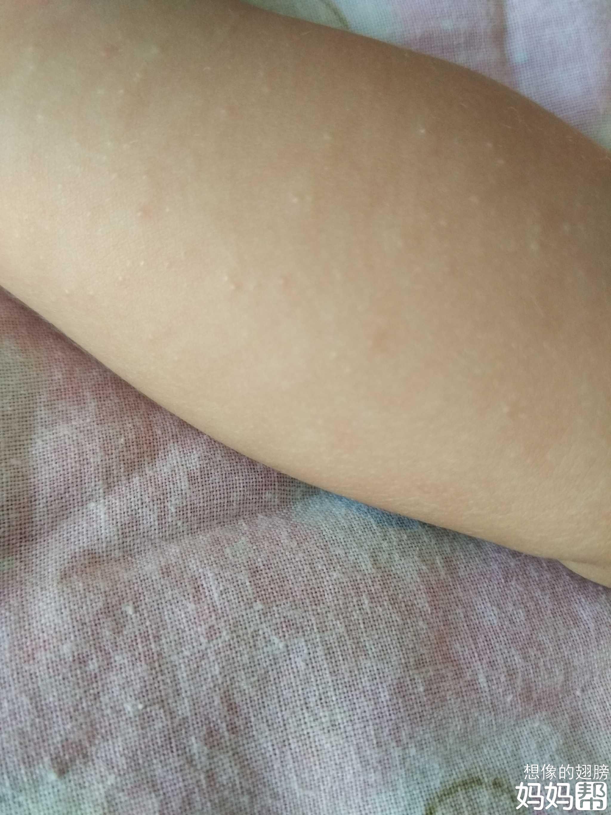 脸上的痘痘几个月都不消
