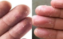 小孩手蜕皮是怎么回事