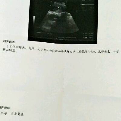 怀孕孕囊图片