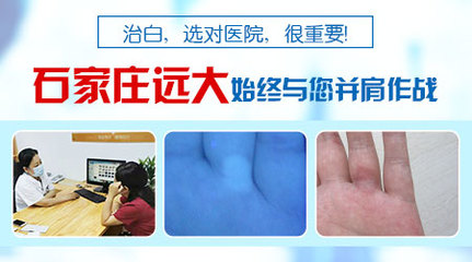 白癜风该怎么治疗好