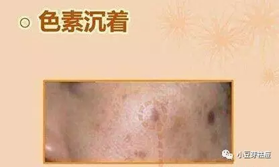 痘印变黑了还能好吗