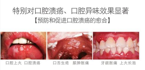 鼻子上生疮是怎么回事