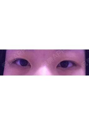 单眼皮怎么整双眼皮
