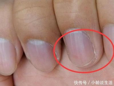 指甲有裂纹是怎么回事