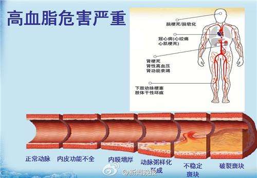 总胆固醇偏高怎么治疗