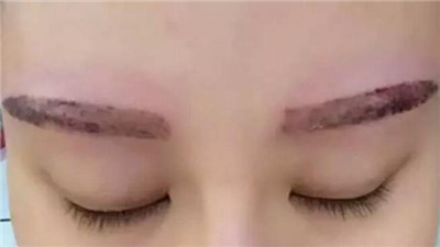 激光洗眉毛多少钱啊