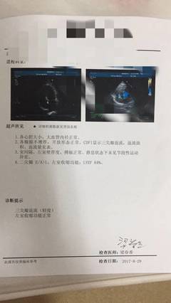 左心脏增大是怎么回事
