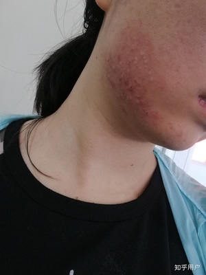 痘痘怎么能治好