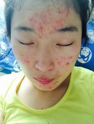 怎么根治痘痘的方法