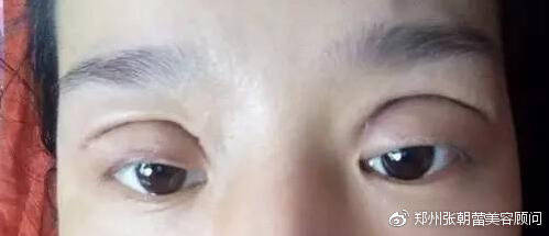 下眼皮凹陷修复哪里好