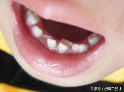 宝宝换牙长歪了怎么办