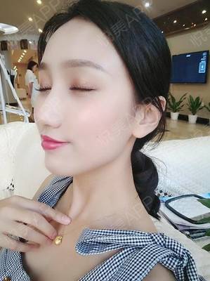 开眼角拆线后多久化妆