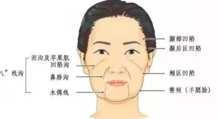 脸部射频