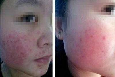 脸上痘痘发痒