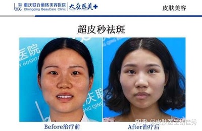 祛斑有什么副作用