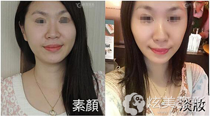 耳软骨隆鼻容易歪吗