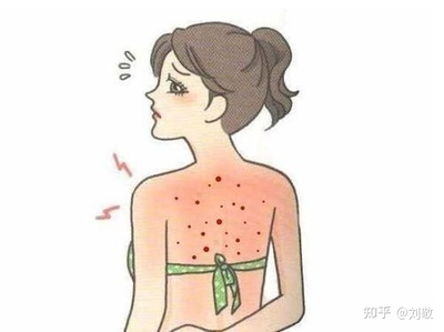 脸上后背长痘痘怎么办