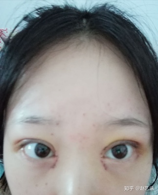 双眼皮就剩睫毛根部肿