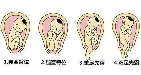 胎儿臀位