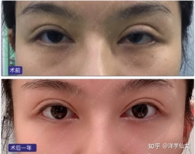 双眼皮上面又条折痕
