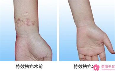 重庆去疤痕