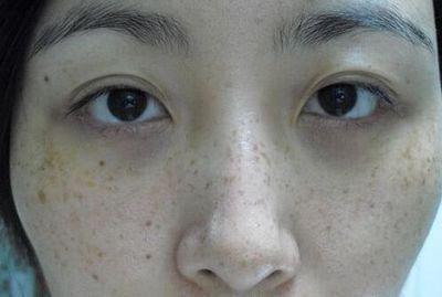男士脸上长痘痘是什么原因