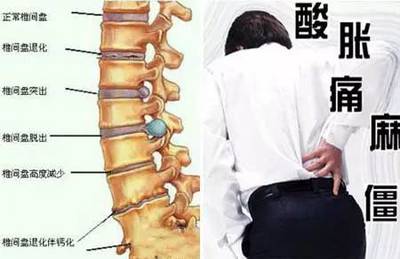 腰椎间盘突出怎么治疗最好
