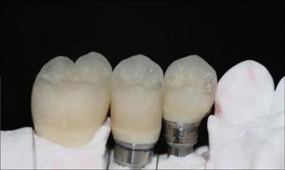 烤瓷牙可以管多久