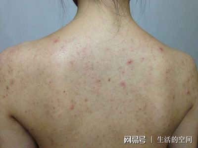 痘痘形成痤疮怎么办