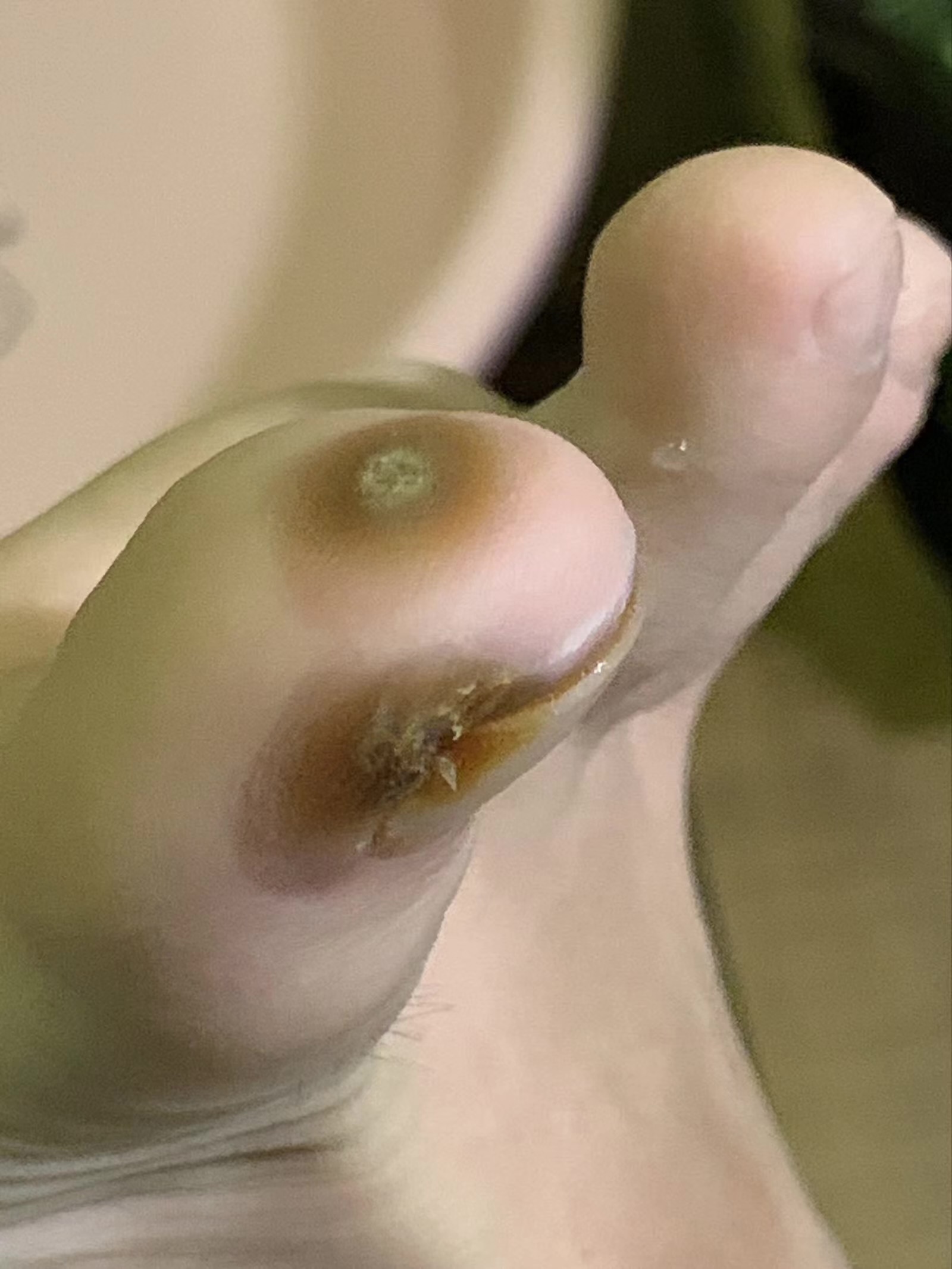 手指甲蜕皮是怎么回事