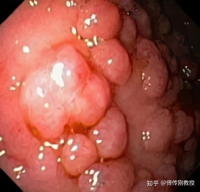 直肠腺瘤怎么治疗方法