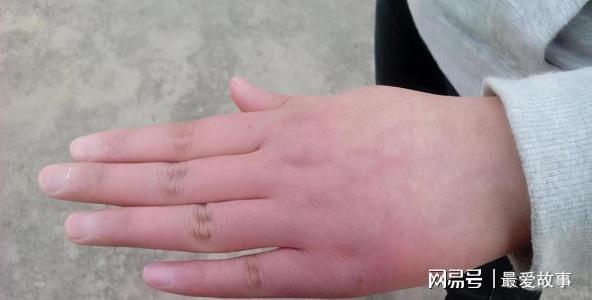 早上起来手发胀是怎么回事