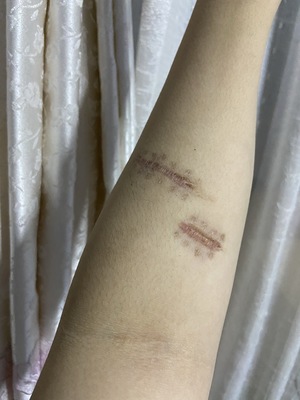 美皮护对老疤痕有用吗