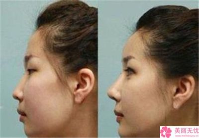 隆鼻效果怎么样