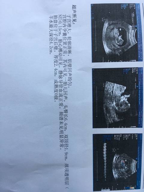 胎儿双顶径标准看男女