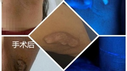 腋下有白斑是怎么回事