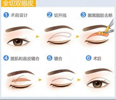 全切双眼皮和埋线哪个好