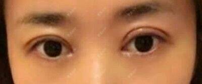 双眼皮做完一个月还肿